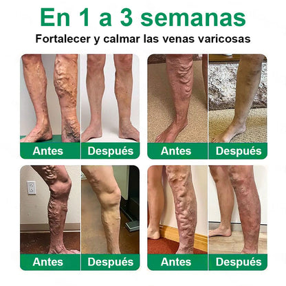 ✨ Healrize® VeinTarget – parche avanzado con microagujas para várices 🔥 96 % de eficacia clínicamente comprobada ✨ Resultados visibles en solo 7–14 días 🌿 Efecto de apoyo suave para piernas más ligeras y relajadas